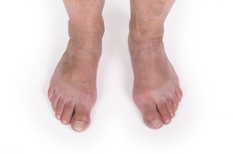 Preventing Varicose Veins Properly